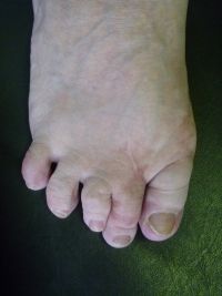 Ятрогенный Hallus valgus. Молоткообразные пальцы. Метатарзалгия.